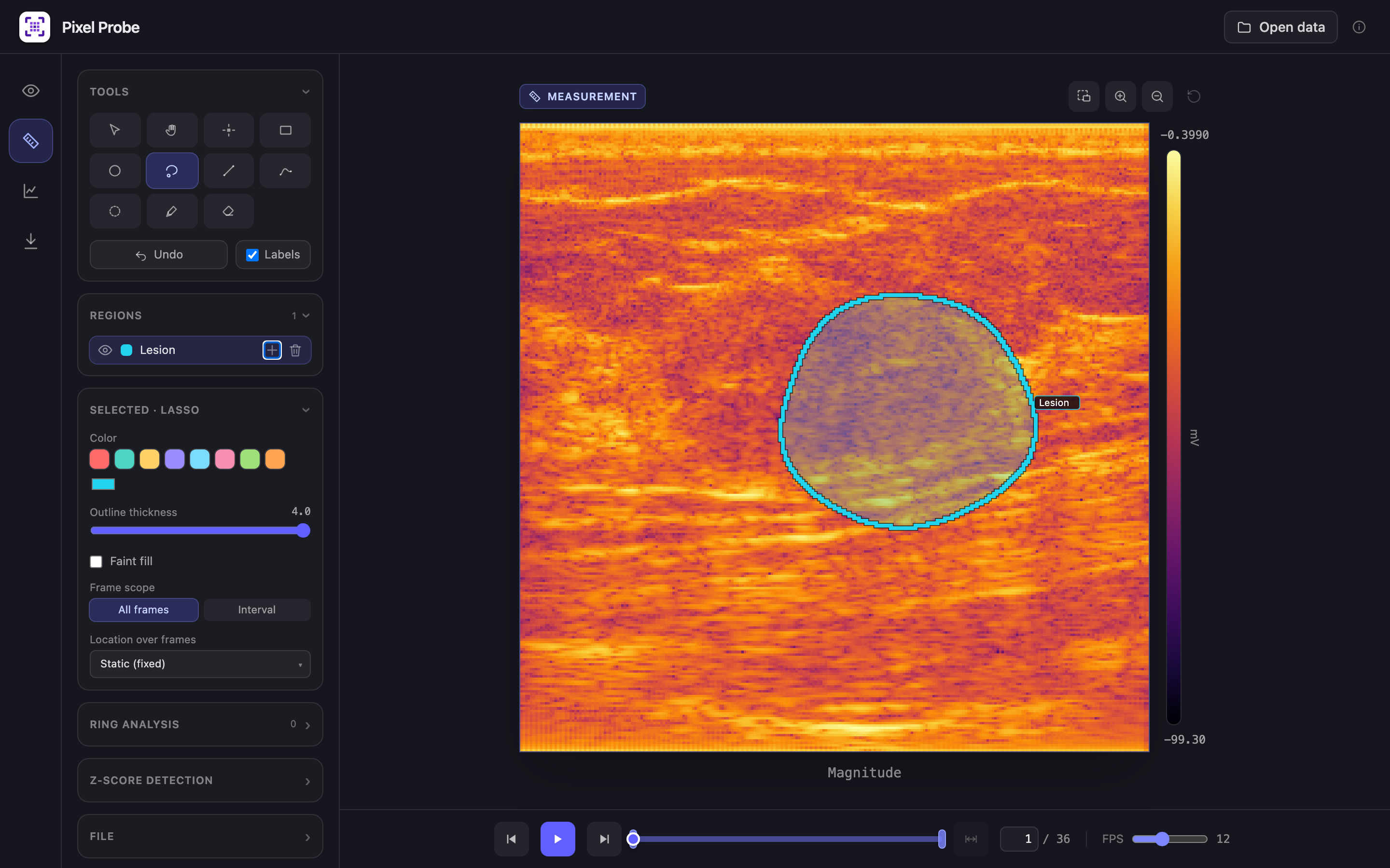 Measurement view with a freehand lasso region drawn around a breast lesion, labeled Lesion