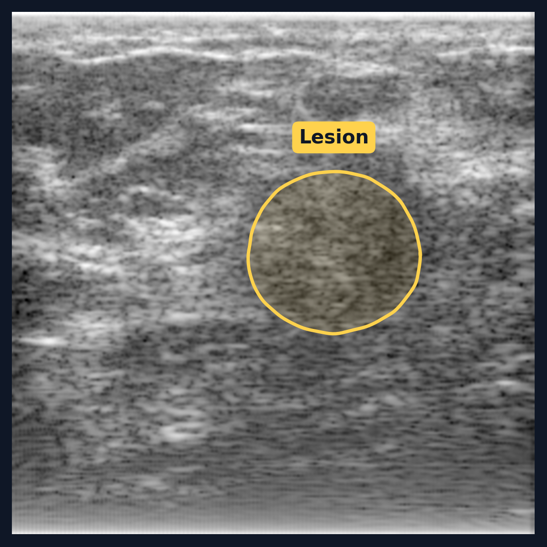 Lesion outlined on a B-mode image